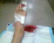 Toe crushed by kayak